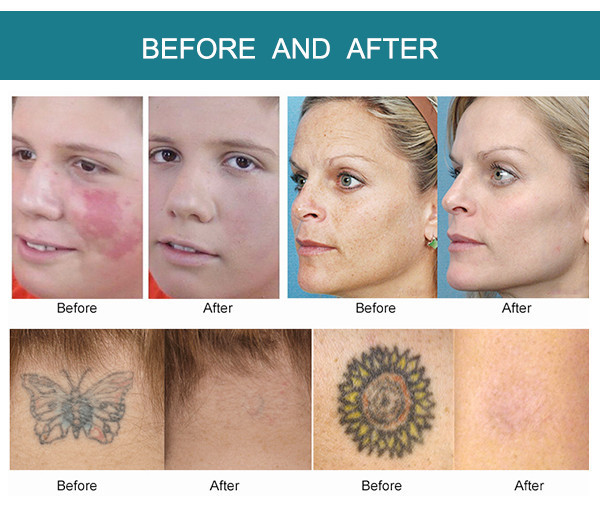 SW-H755 picosure laser sunburn removal tattoo freckle removal pigmentation nevus removal 755 picosure picolaser picosecond laser