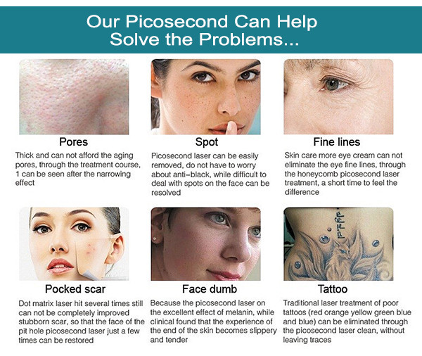 SW-H755 picosure laser sunburn removal tattoo freckle removal pigmentation nevus removal 755 picosure picolaser picosecond laser
