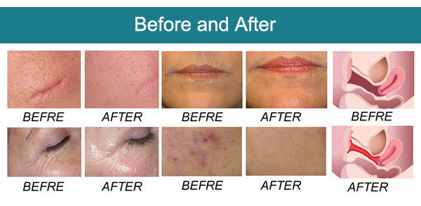 SW-E10 fractional laser co2 private health sunburn removal freckle removal acne scar removal rf co2 fractional laser