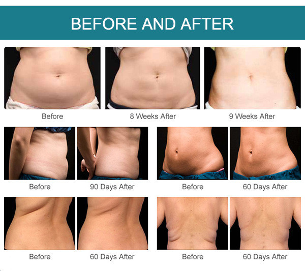 Body Contouring > - Cavitation and Radio Frequency - The CryoLab
