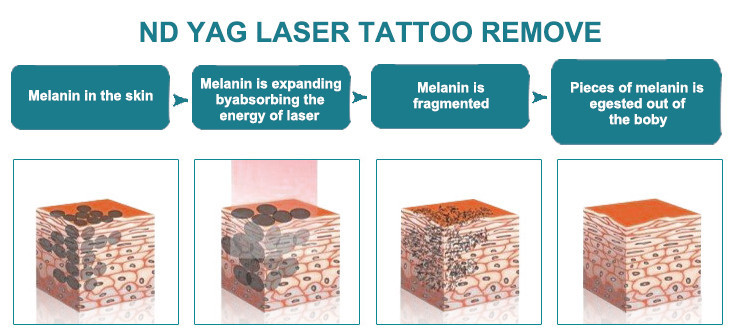 SW-902E nd yag laser beauty device pigmentation treatments pigmentation treatment pore removal pingmentation removal device